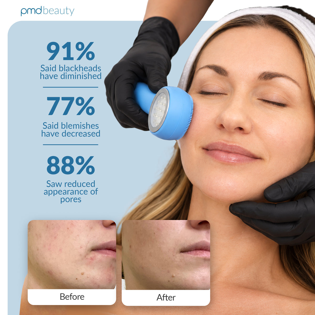 PMD LED Clean Acne