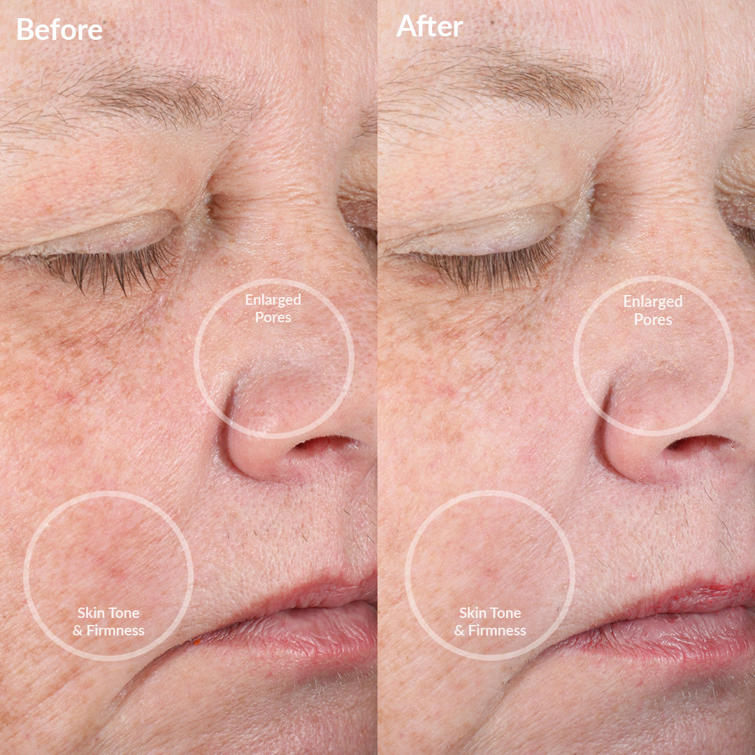 4002-MauveJ-Min? Before and After from the Minnie Mouse PMD Clean Pro JAde