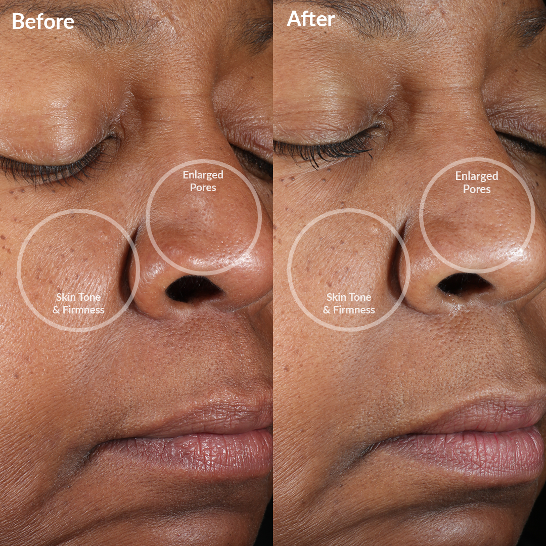 4000-PINK?Before and After Showing Results of the PMD Clean Mini