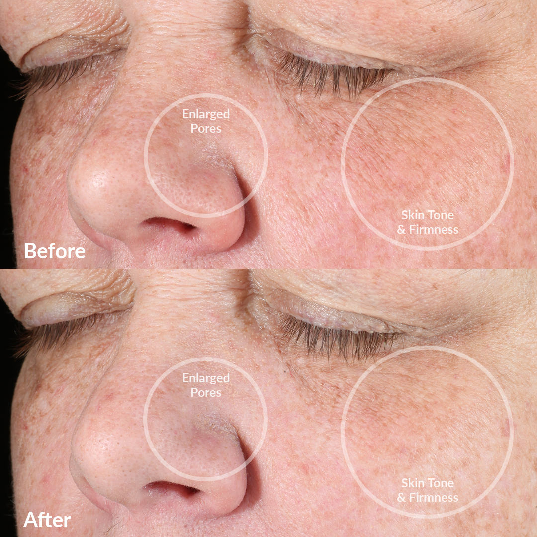 4002-RoseG? Before and Afters With the PMD Clean Pro Gold