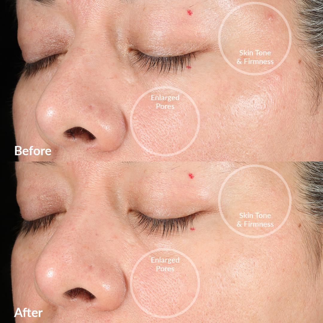 4002-BlackOB? Before and After From The PMD Clean Pro OB