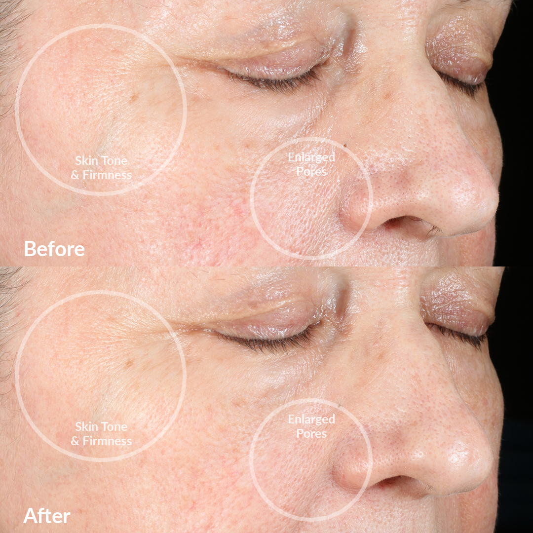 4002-BlushRQ? Before and After Results From The PMD Clean Pro RQ