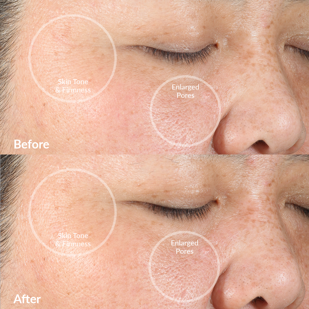 4001-Blush?Clinical trial Before & After using the PMD Clean