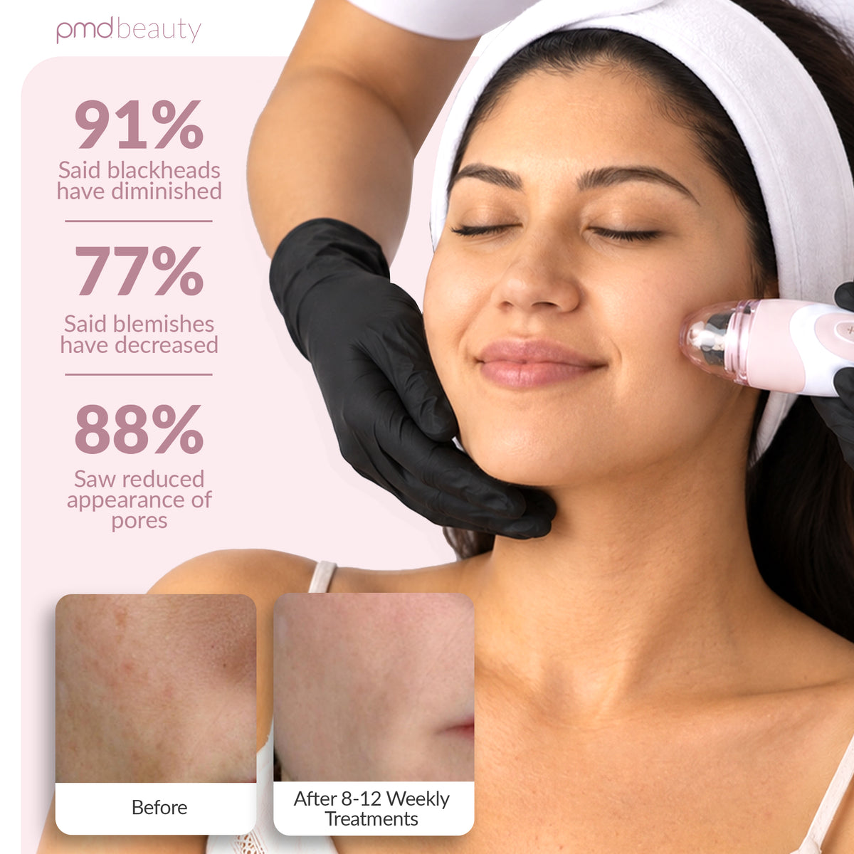 Personal Microderm Elite Pro