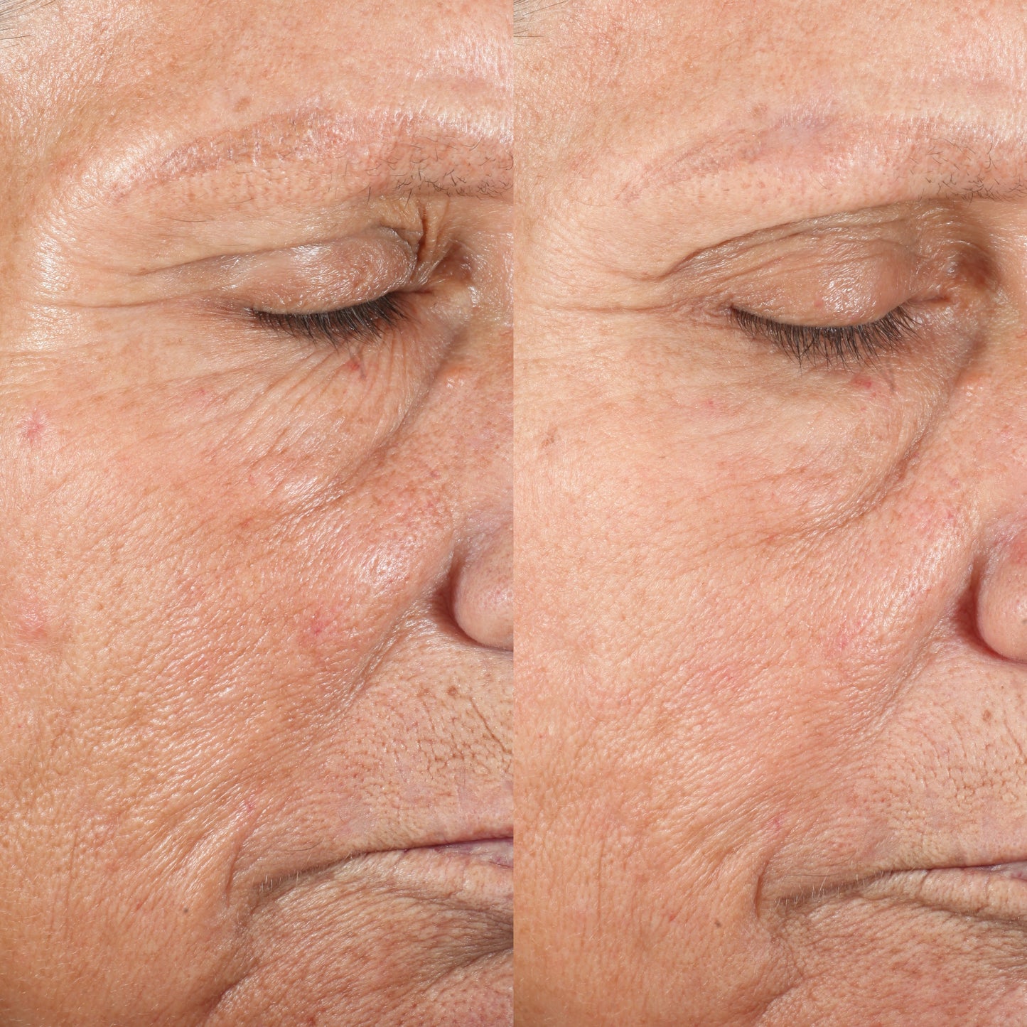 Personal Microderm Elite Pro