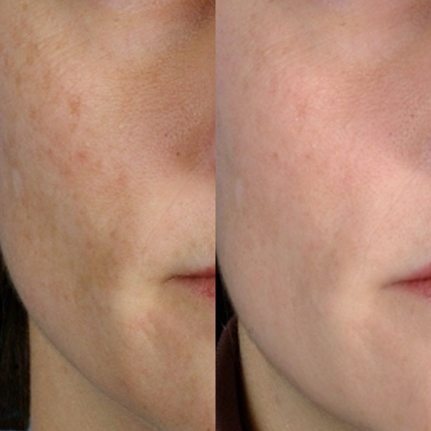 Personal Microderm Classic - International