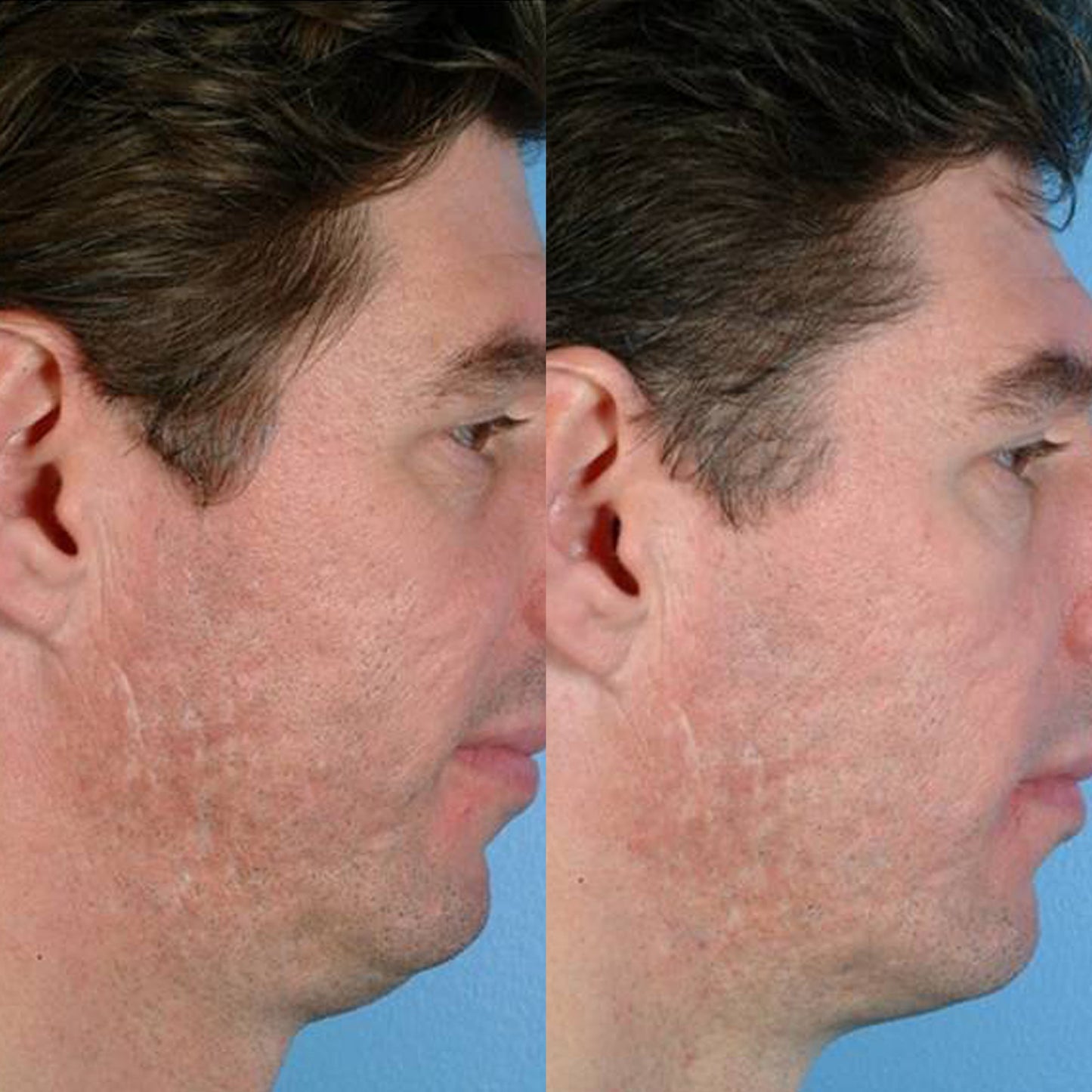 Personal Microderm Man - International