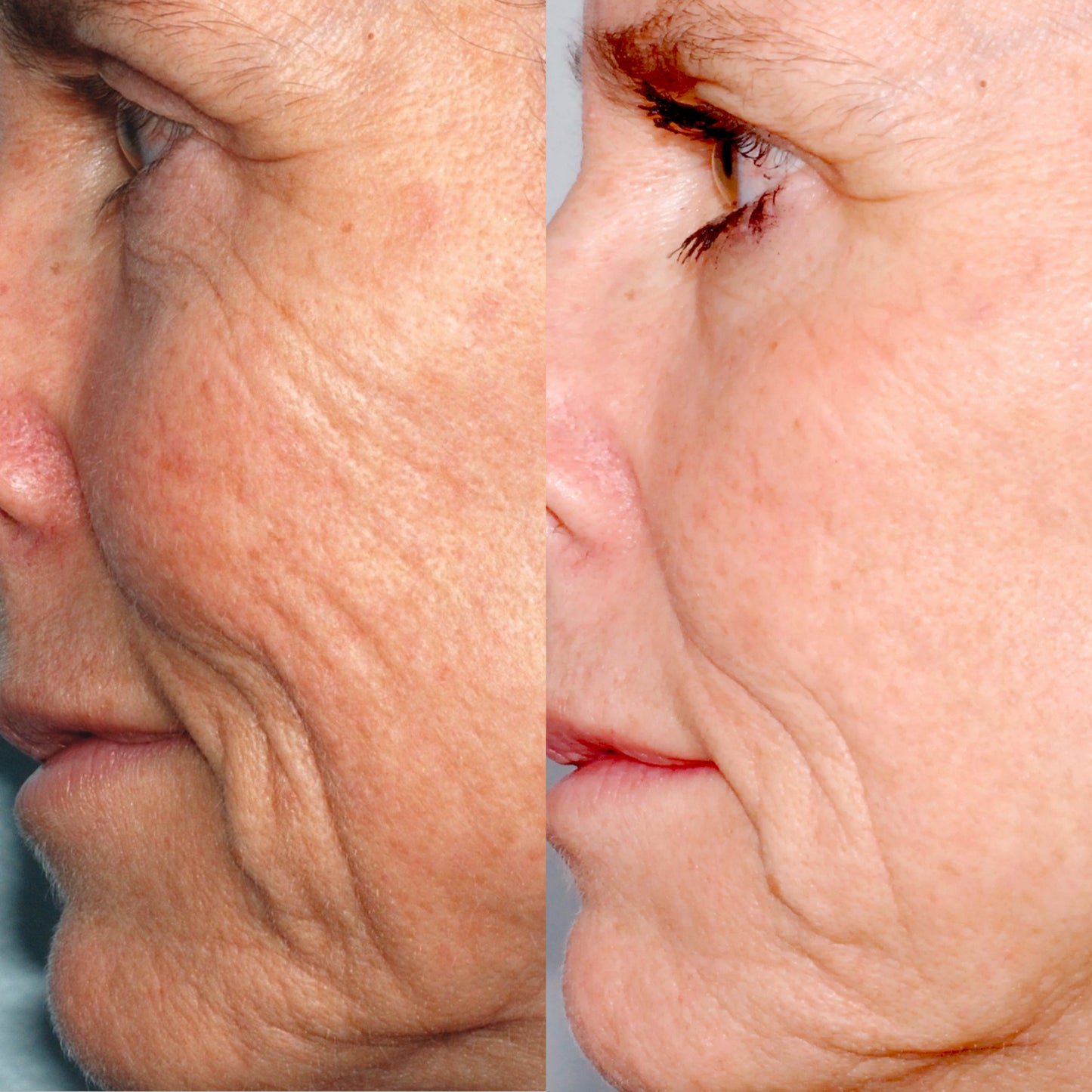 Personal Microderm Pro